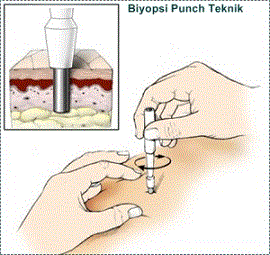 DERİ ‘’PUNCH’’  BİYOPSİ UYGULAMASI