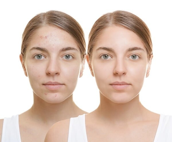 LAZER İLE AKNE (SİVİLCE) İZİ TEDAVİSİ